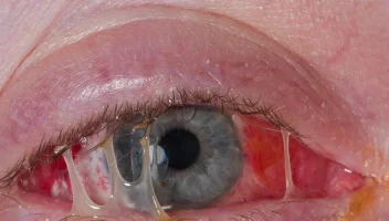 চোখের কোণে কেন পিঁচুটি জমে