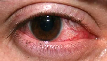 চোখ ওঠা রোগে হোমিওপ্যাথি