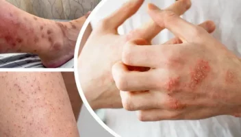 ছোয়াচে রোগ স্ক্যাবিস