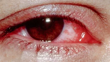 চোখ লাল, অবিরত পানি পড়ে