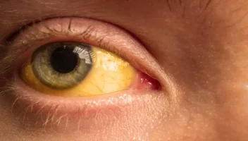 হেপাটাইটিস ‘ই’ ভাইরাসে জন্ডিস