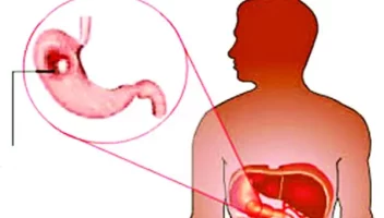 রমজানে পেপটিক আলসার রোগীর সতর্কতা