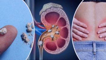 কিডনিতে পাথর কেন হয়?